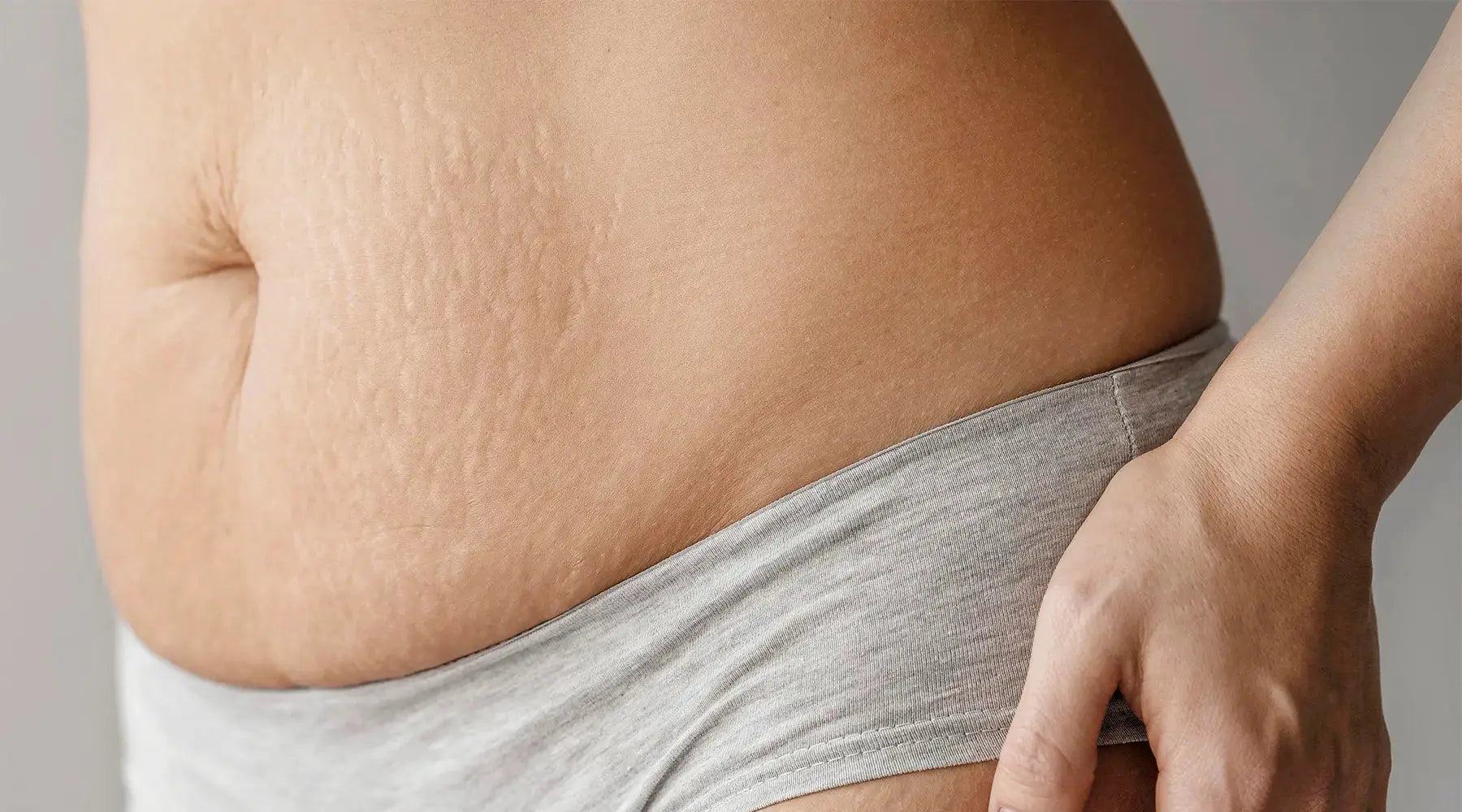 Como Combater a Celulite? NatusVita Suplementos