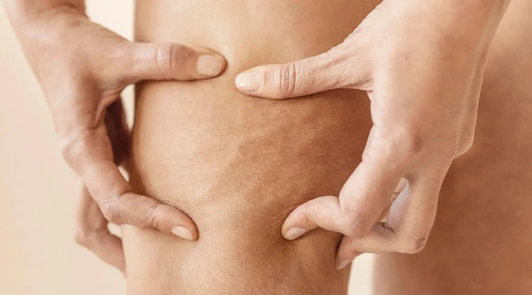 Como combater a celulite? NatusVita Suplementos